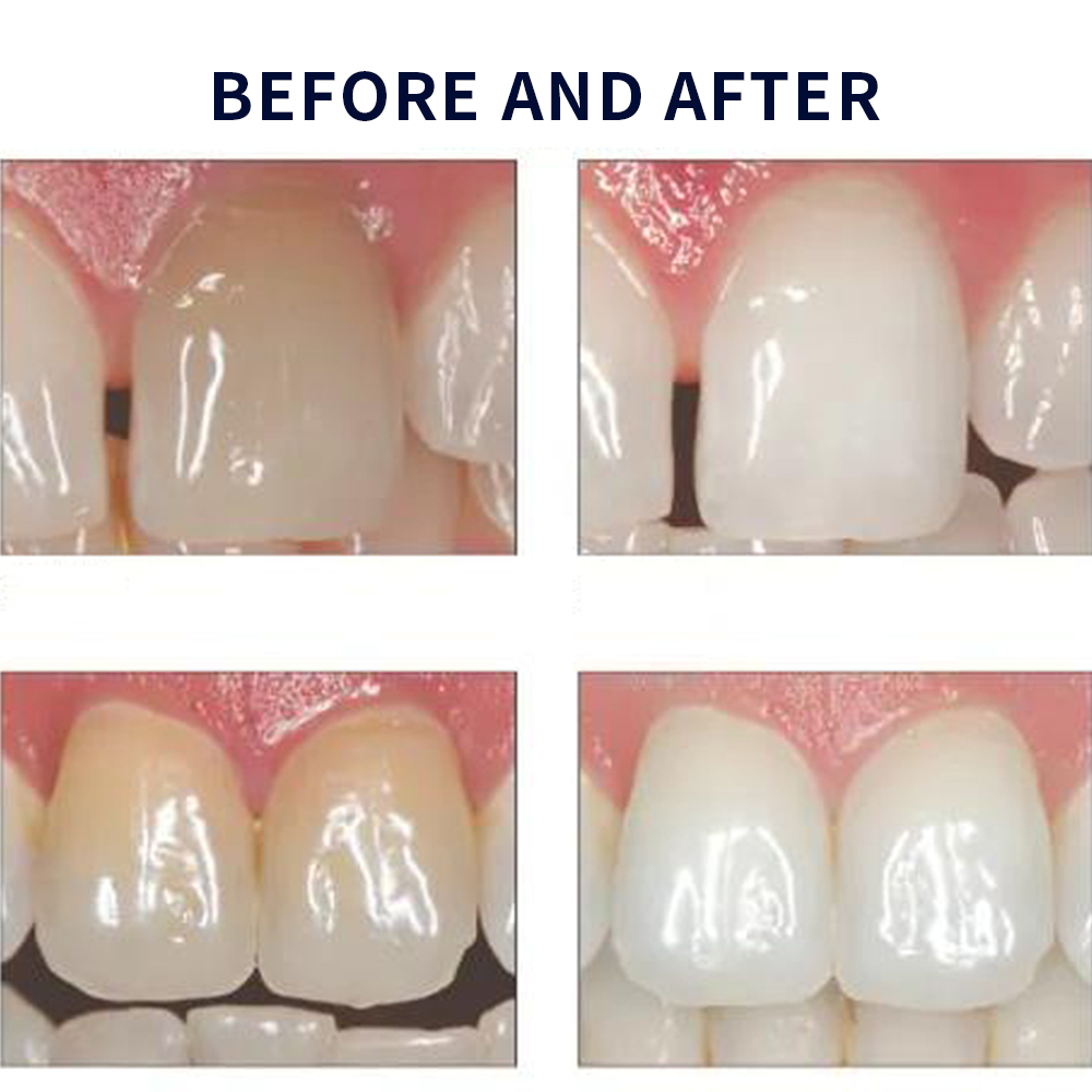 Отбеливающий набор opalution 2 – обзор и цена Teeth Whitening In Office