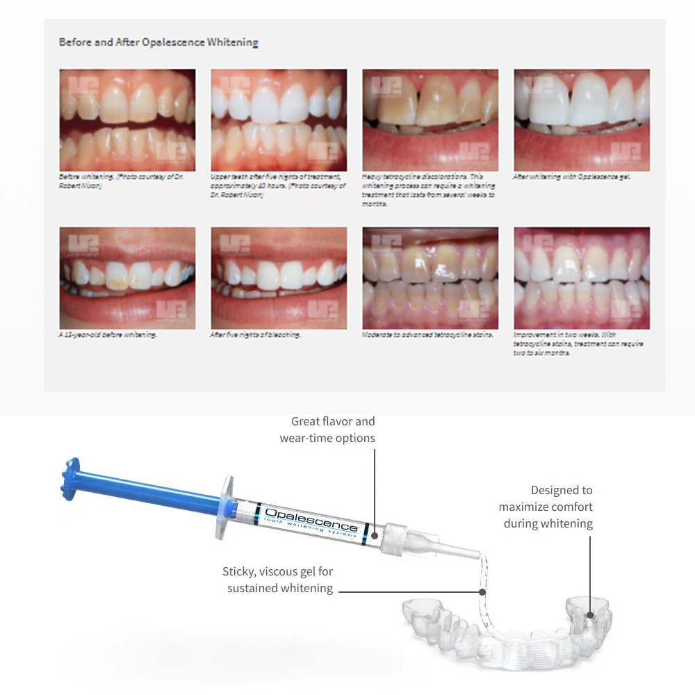 Отбеливающий набор opalution 2 – обзор и цена Teeth Whitening In Office