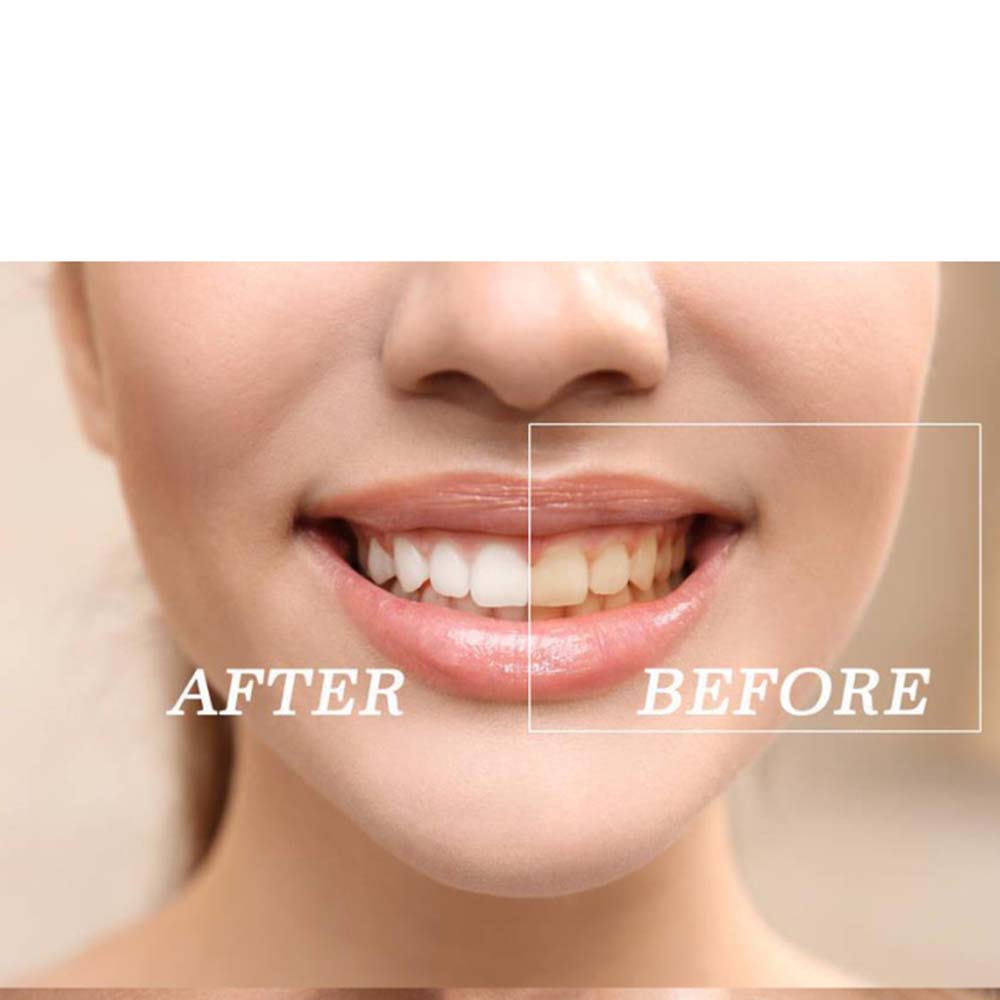 Высокое качество пероксид отбе – обзор и цена Teeth Whitening Bleach