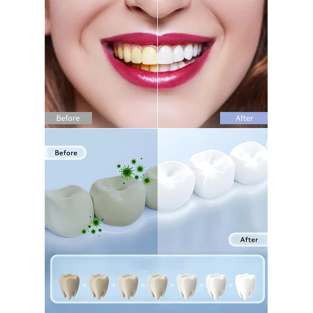 1 шт., бытовая умная светодиод – обзор и цена Teeth Whitening In Office